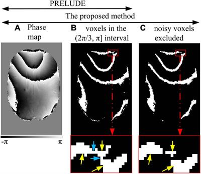 A new 3D phase <mark class="highlighted">unwrapping</mark> method by region partitioning and local polynomial modeling in abdominal quantitative susceptibility mapping